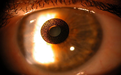 Aspecto del ACI Corneal Inlay en el ojo