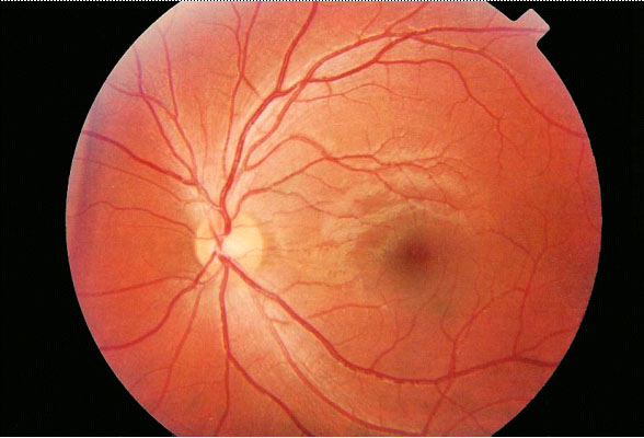 Aspecto del fondo del ojo con una retina normal