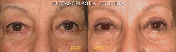 Blefaroplastia estética