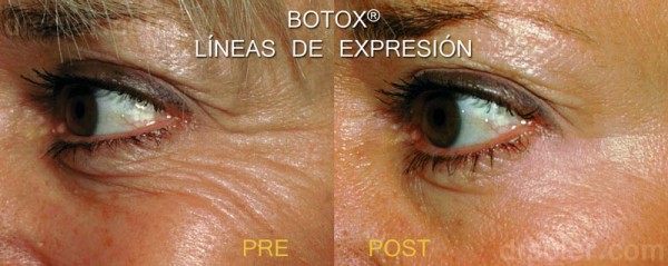 Botox® y líneas de expresión