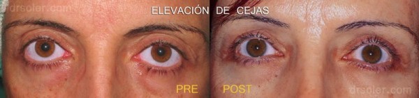 Elevación de cejas