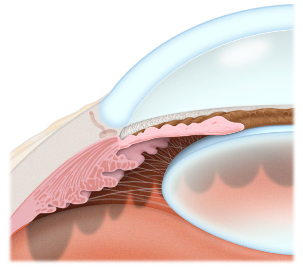 En el glaucoma crónico simple o de ángulo abierto las estructuras oculares son aparentemente normales y el ángulo que forman iris y córnea está despejado.