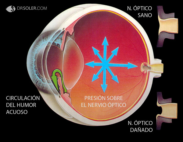 En el glaucoma, el nervio óptico queda dañado por la presión. Imagen: Internet - Stephen F. Gordon