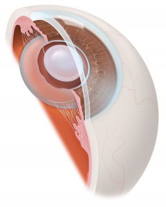 Se sustituye el cristalino por una lente intraocular