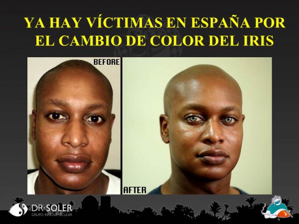 Victimas en España por el cambio de color del iris